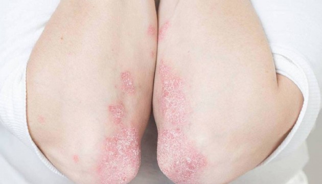 Doktorlar uyardı: “Kelebek hastalığı” lupus hayati organları etkileyebiliyor