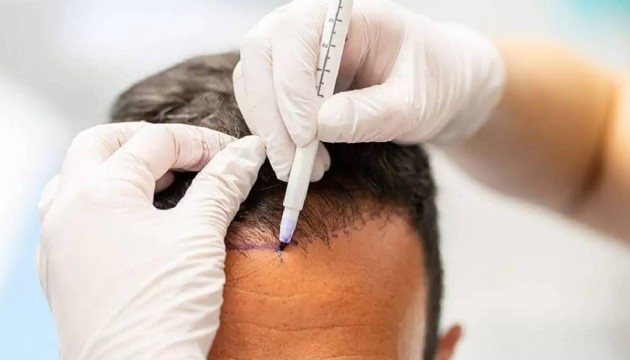 Hekim olmadığı halde saç ekimi yapan kişiye hapis cezası