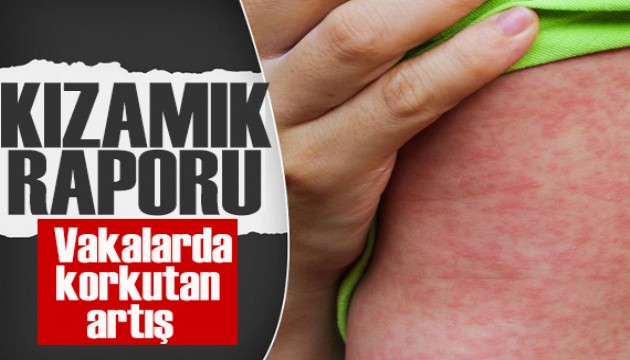 DSÖ'den korkutan rapor: Kızamık vakaları son 25 yılın en yüksek seviyesinde!