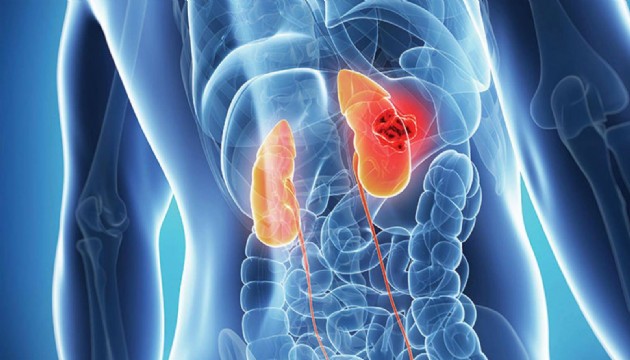 Böbrek kanserinde yeni bir alt tür tanımlandı