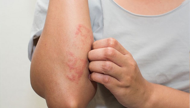 Eğer cildinizde bu yaz 3 belirtiyi görürseniz hemen doktora başvurun!