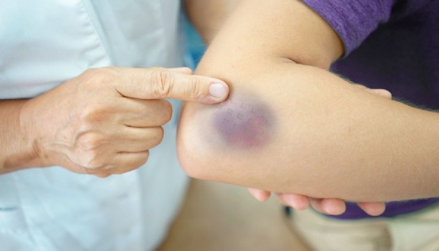 Uzman isim uyardı: Geçmeyen morarmalara dikkat!