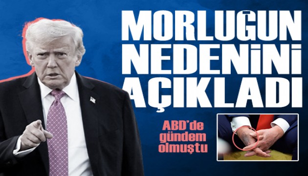 Trump’tan sağlık iddialarına yanıt: Elindeki morluğun nedenini ilk kez açıkladı