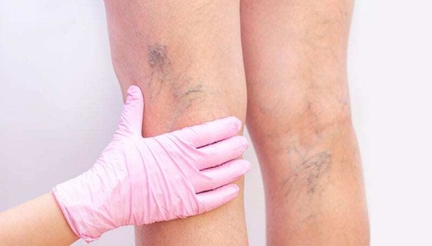 Uzmanı uyardı: Varis vücutta ‘Pıhtı’ riskini artırabilir